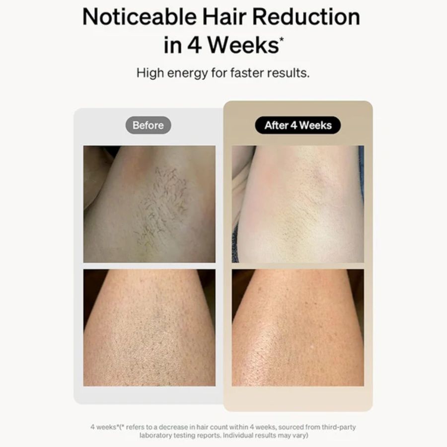 Laser Hair Removal 900,000 Flashes 5 Gears IPL Laser Epilator Hair Removal Device for Armpits Legs Arms Bikini Line LCD Display Hair Remover - Discount Msrp 