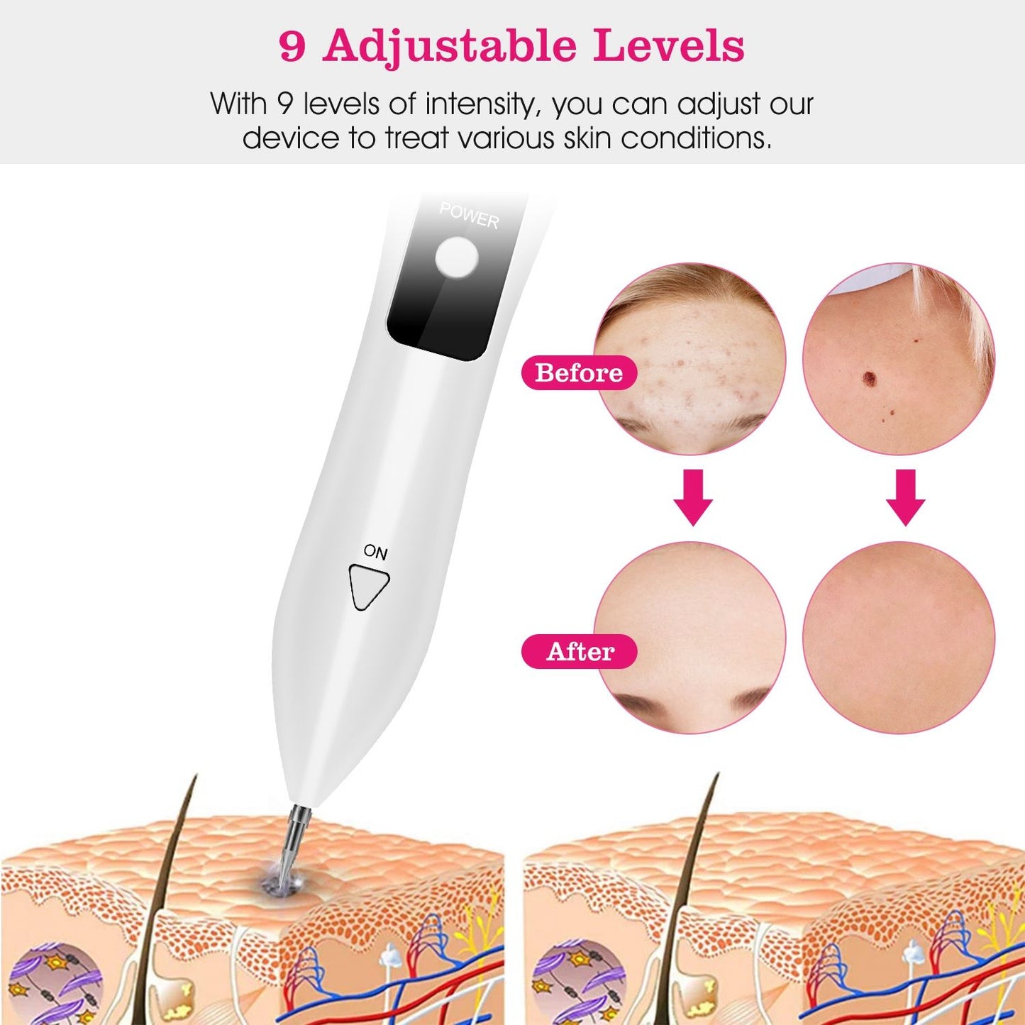 Skin Tag Repair Kit Portable Beauty Equipment Multi-Level with Home Usage USB Charging LCD Level Adjustable 6 Replaceable Needles - Discount Msrp 